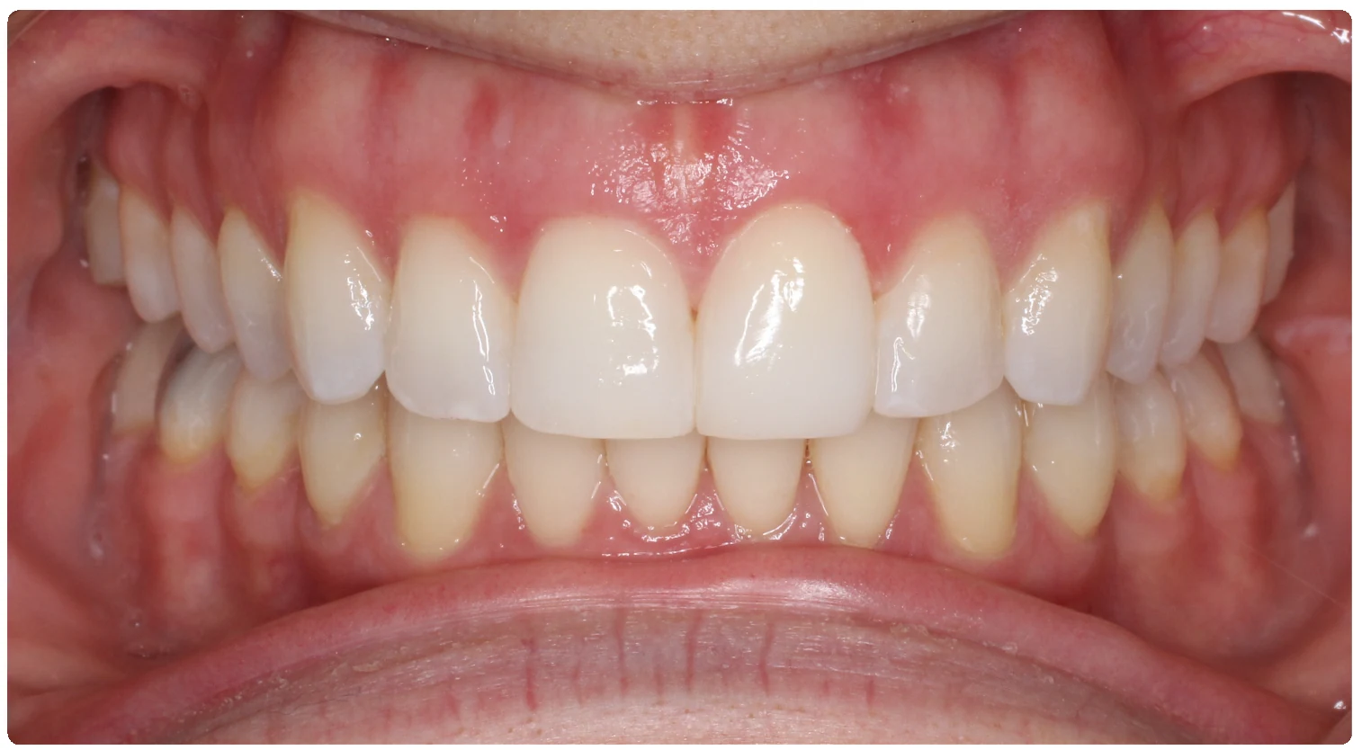 After treatment smile close-up 1