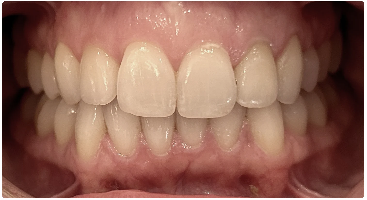 After treatment smile close-up 3