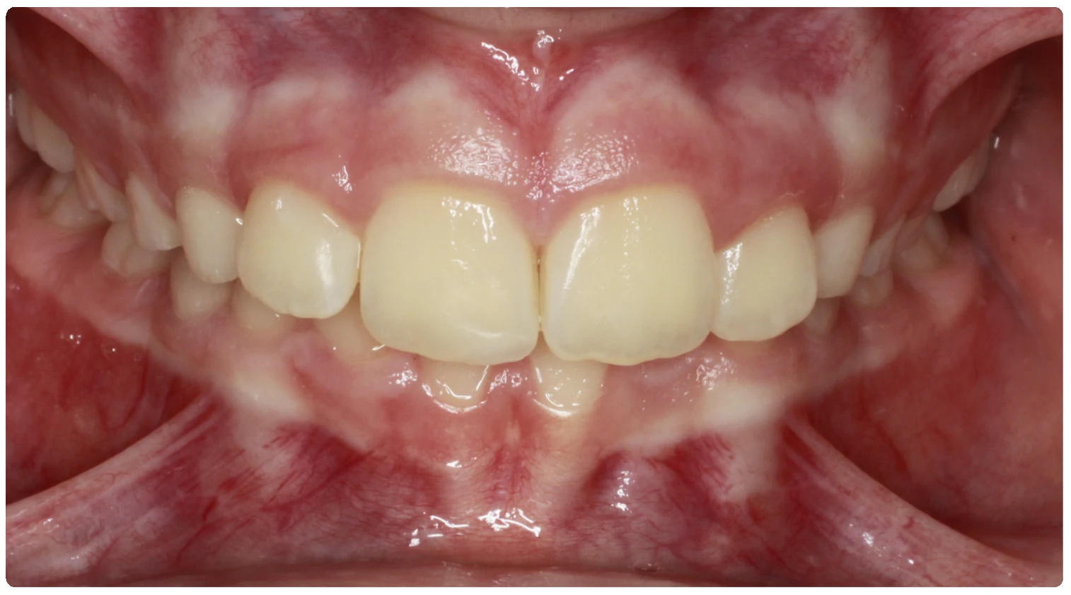 Before treatment smile close-up 5