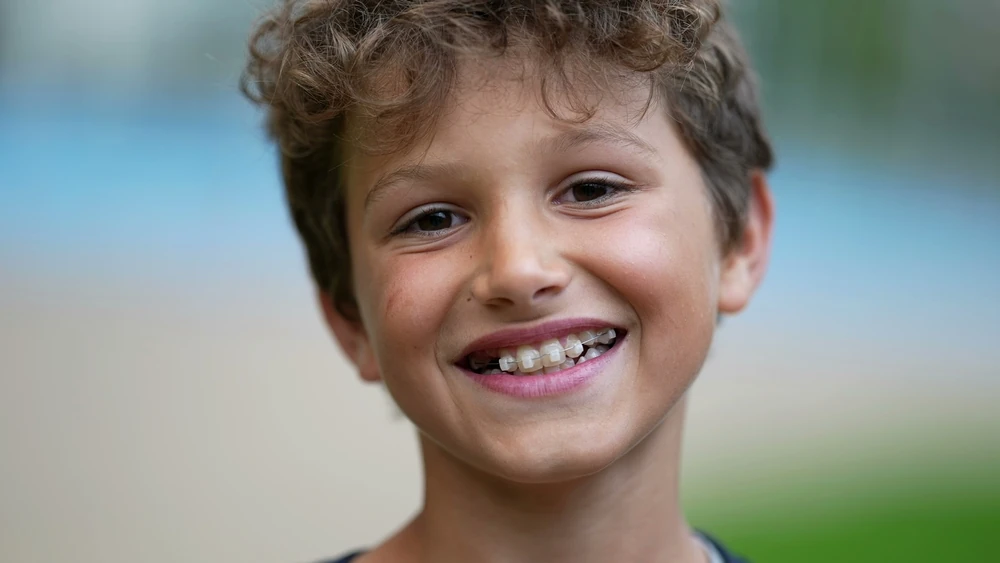 Temporary anchorage device orthodontic treatment